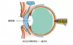 治疗白内障的有效方法是什么？成都爱